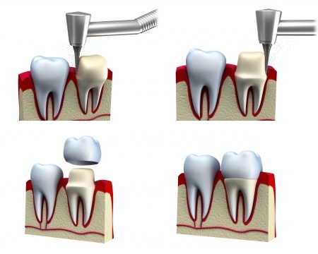 Santa Rosa Dentist Crown